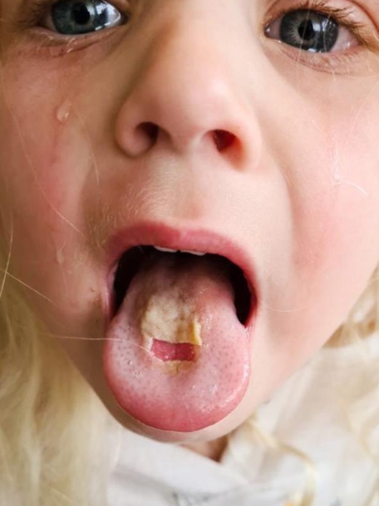 Supplied Editorial Parents are being warned sour lollies can cause burns to young  children. Picture: Facebook