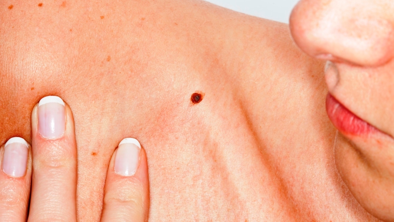 Australian researchers develop blood test capable of detecting melanoma