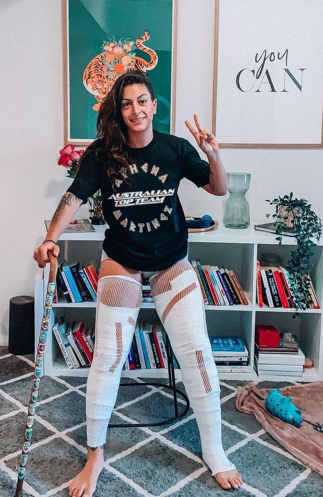 Athena Martinez’s severe burns from cryotherapy. Picture: Supplied