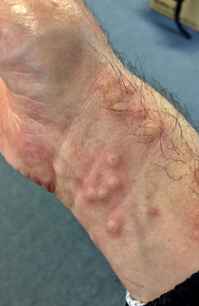 Balmoral Beach swimmer David Sanney was stung by a jimble in 2016. He said the welts appear a few days after the sting. Picture: Supplied