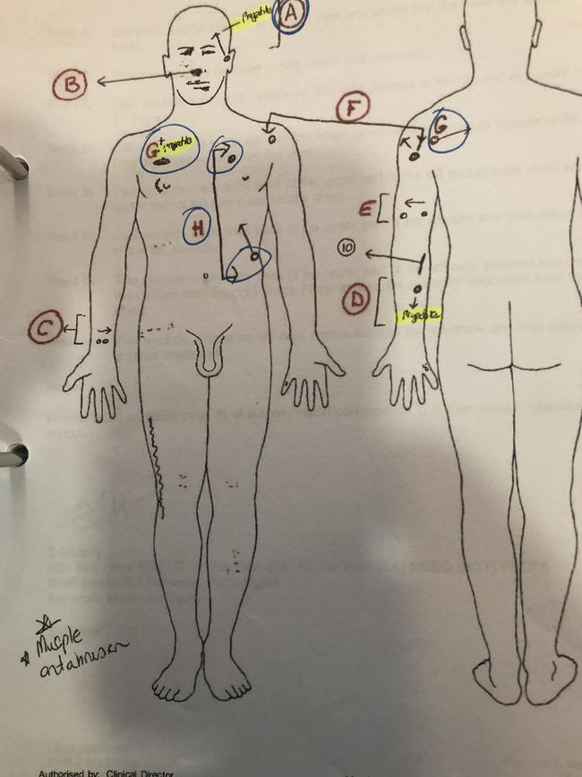 Coroner’s illustration of Mehmet Yilmaz’s fatal injuries.