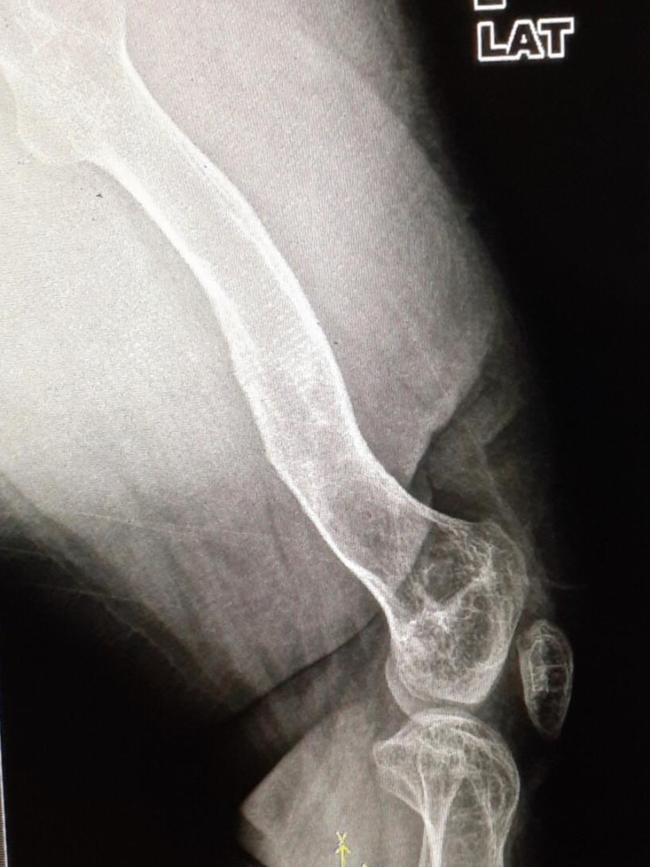 X-rays of Sonia’s leg shows how her femur has become “bent and squiggly” and her knee deformed, due to the childhood infection, Prof Minoo Patel said.