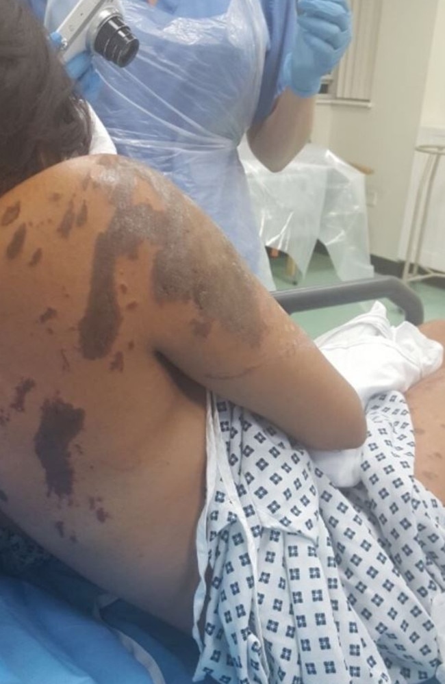 Her burns have been described as ‘life changing’. Picture: GoFund Me