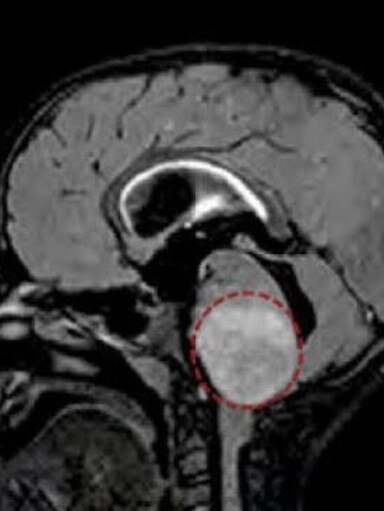 Annabelle Nguyen’s scans before the treatment.