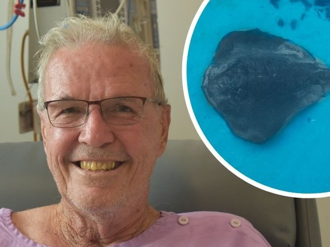 A sting ray barb went through Mackay angler David Murphy's leg. Picture: Contributed