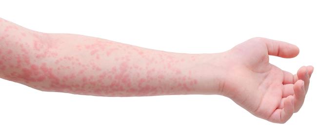 Young asian child arm skin with rash over white background