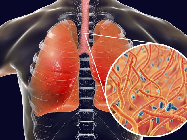 Whooping cough, conceptual illustration. Whooping cough is a highly contagious infectious disease caused by Bordetella pertussis bacteria. The main symptoms are paroxysms of cough and inspiratory whoop. B. pertussis are gram-negative, aerobic, non-motile, coccobacillus bacteria. They are spread by coughing and by nasal drops. The incubation period is 7-14 days. B. pertussis bacteria initially locate in nasopharynx where they multiply and produce number of toxins including tracheal cytotoxin (TCT). TCT causes extensive damage to ciliated epithelial cells of trachea and contributes to the cough characteristic of pertussis. Treatment is with antibiotics. A vaccine is available for this bacterial pathogen. Pertussis vaccine is part of the DTaP (diphtheria, tetanus, acellular pertussis) immunization.