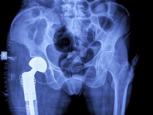 The way hip and knee replacement surgery is priced will be reassessed. Picture: istock