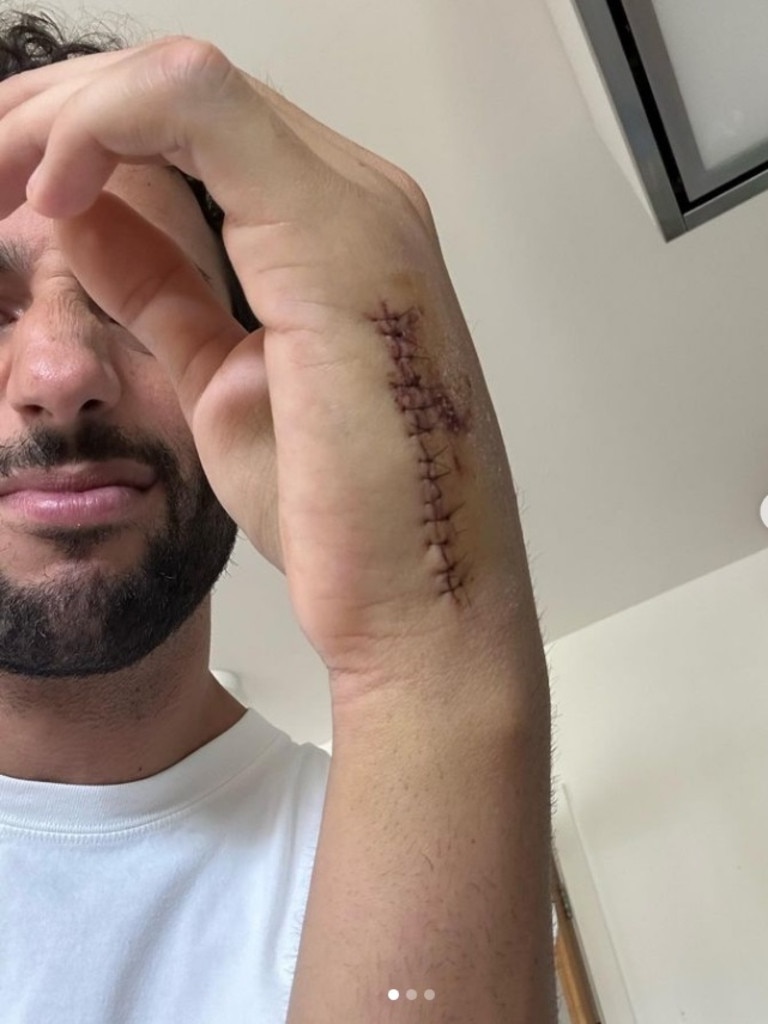 Daniel Ricciardo showing off his gnarly scars. Photo: Instagram.