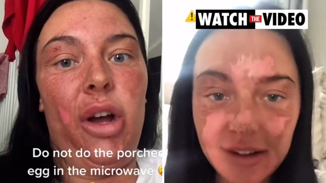 Viral egg hack destroys woman’s face