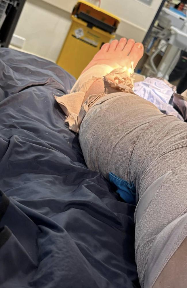 Braydon Brighton’s bandaged leg in Bundaberg Hospital. Braydon survived his second brown snake bite this week, driving himself 2km to call for help and using his work shirt as a tourniquet.