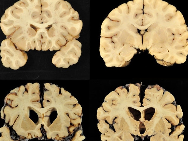 This combination of photos shows sections from a normal brain, top, and from the brain of former University of Texas football player Greg Ploetz, bottom, in stage four of chronic traumatic encephalopathy (CTE). Picture: LiveScience