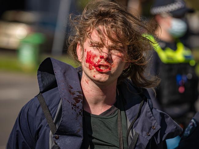 A bloodied protester after violence erupted. Picture: Jason Edwards