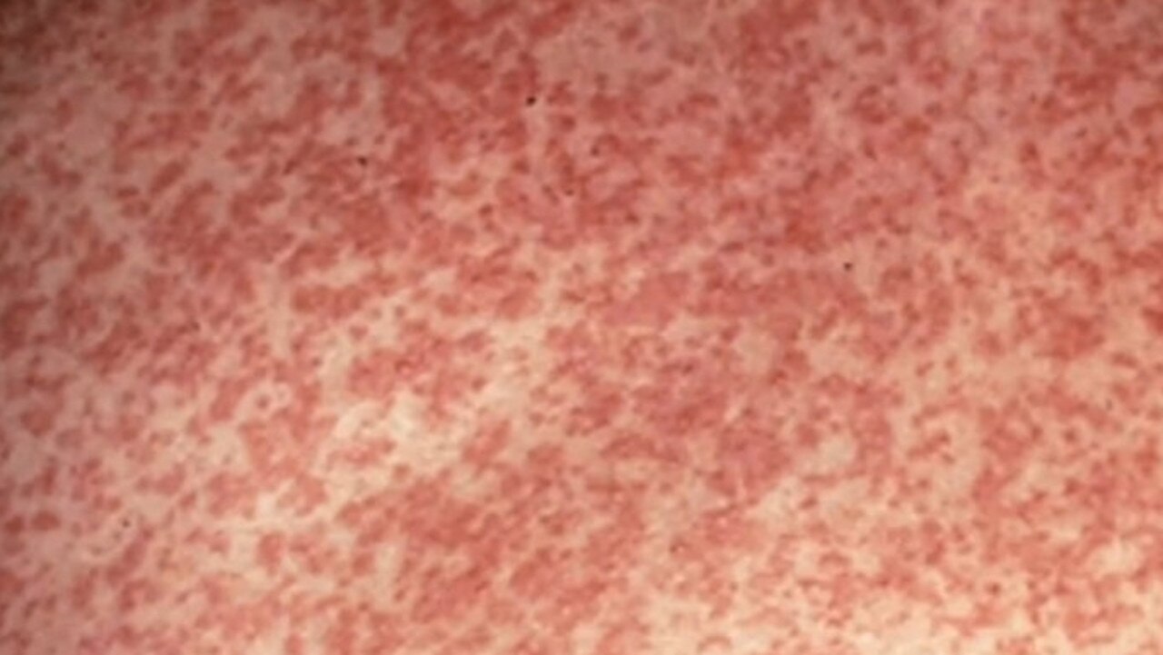 Measles outbreak spreads as baby infected