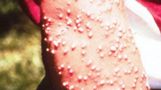 Pustules resulting from fire ant stings. Photos: Invasive Species Council