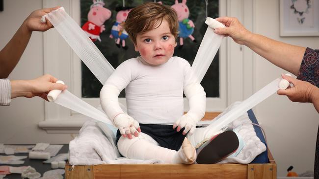 ‘Butterfly boy’ Jacob Burmeister, 2, endures a daily full body bandage change, skin check and wound dressing that can take more than two hours. Picture: David Caird