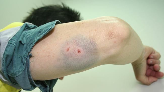 Ergon Energy file photos of previous injuries on meter readers.