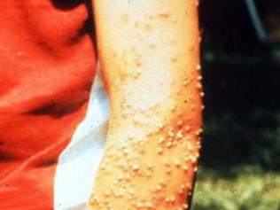 Allergic reaction ... A boy shows off his fire ant bites. 