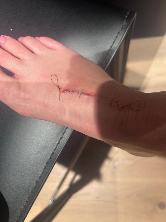 Hodgson had to have a steel plate put in her foot after she ruptured her lisfranc ligament and broke the bones in her foot. Picture: Supplied