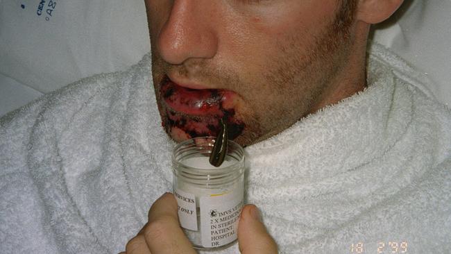 A man has a leech attached to his lower lip after a dog attack in South Australia.