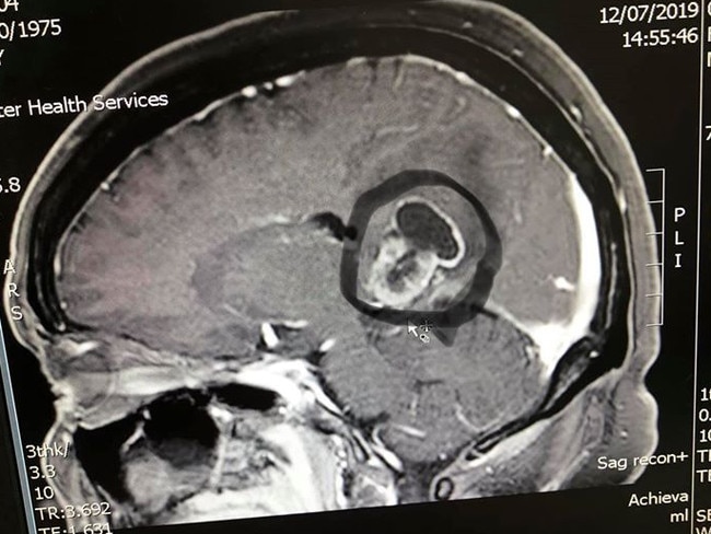 Doctors found a brain tumour in July this year. Picture: Supplied.