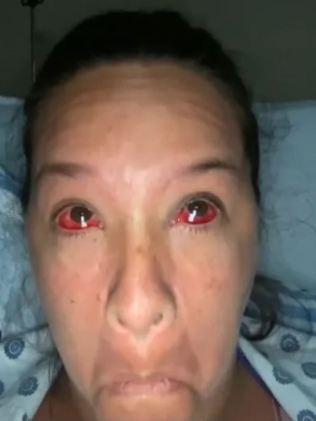 Maira shows off the blood vessel damage. Picture: TikTok