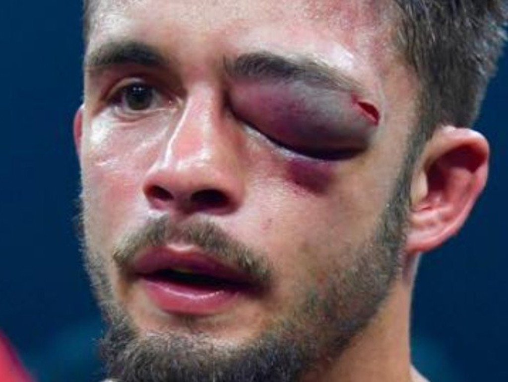 Anthony Yigit's face is absolutely devastated after fight with Ivan Baranchyk.