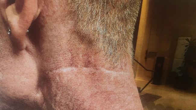 The scar Mr Whitehead was left with after the attack by Mr Robinson. Photo: Courts SA