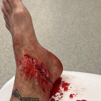 Joel Burum-Mikelat's injured ankle.