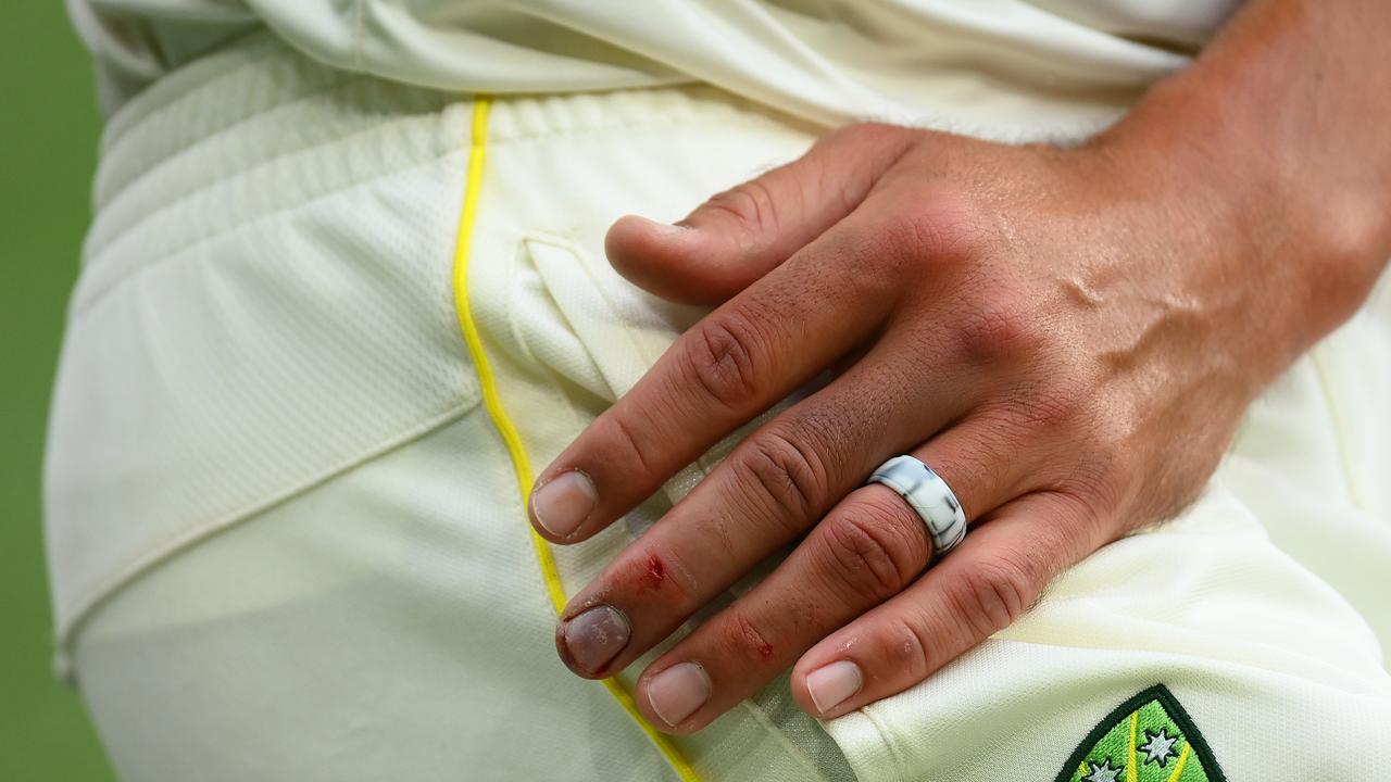 Mitchell Starc’s busted bowling finger. Picture: Quinn Rooney/Getty