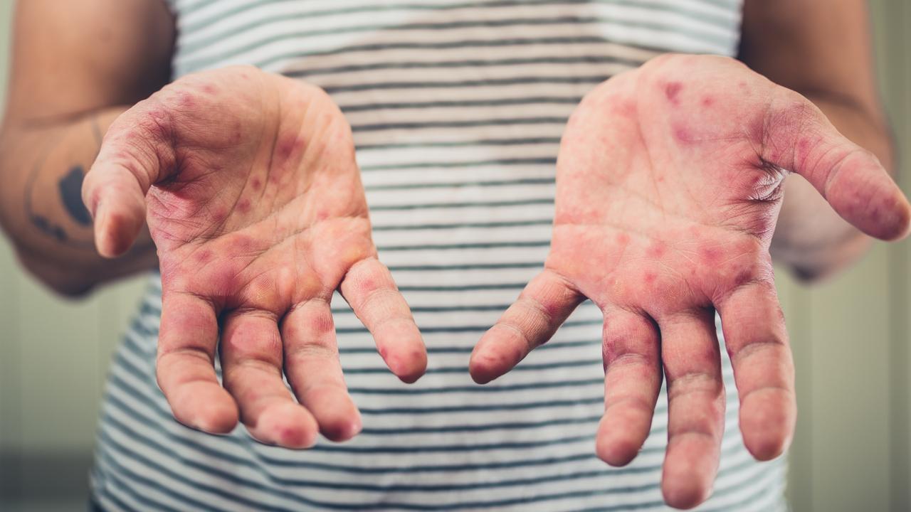 Measles has a characteristic red blotchy rash. Picture: Supplied