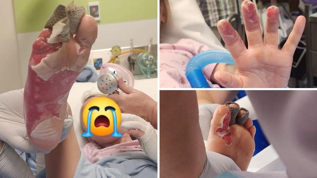 A seven-year-old girl left with third-degree burns to her feet and hands after stepping on a hidden campfire buried under sand at Keelbottom Creek near Mingela on Sunday. Picture: Facebook/Ashlea Hodder