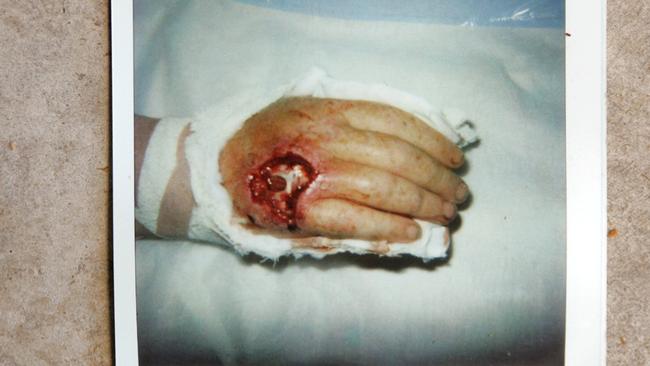 What flesh eating bacteria looks like.