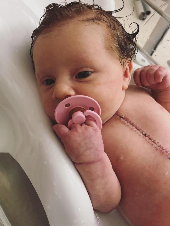 Haddie Filisetti had her first open heart surgery at just three days old.