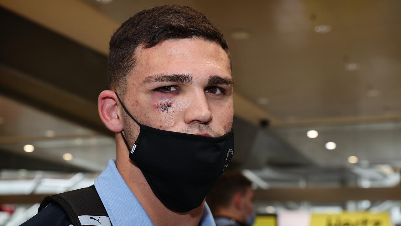 Nathan Cleary shows the scars of Origin I on his return to Sydney. Picture: NCA NewsWire/Dylan Coker