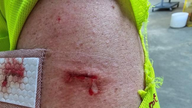 A picture of a postie injured after a vicious dog attack on their arm while out delivering. Picture: Supplied