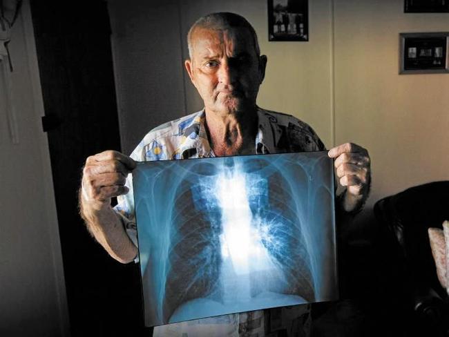 Ipswich man Percy Verrall was diagnosed with black lung disease in 2015.