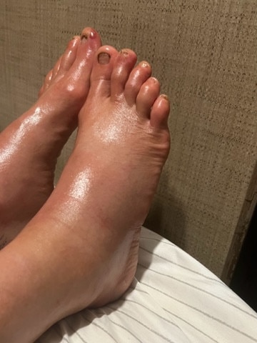 Julie Sager's feet after the Bigfoot 200 race in Washington state, USA. Picture: Supplied