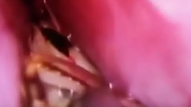 Doctors removed a live cockroach from inside an Indian woman's skull.