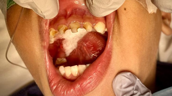 An unidentified young oral health patient from Far North Queensland who recently required surgery due to tooth decay. Picture: Supplied