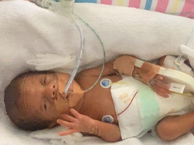 Mia was born at 24 weeks and four days, weighing just 636g.