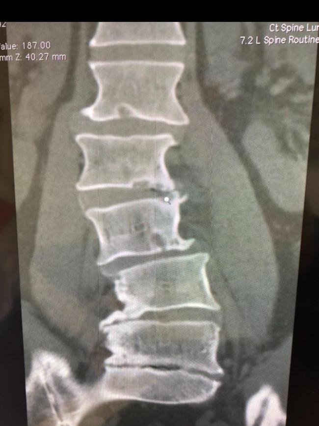 Dermott Brereton’s back x rays. Supplied