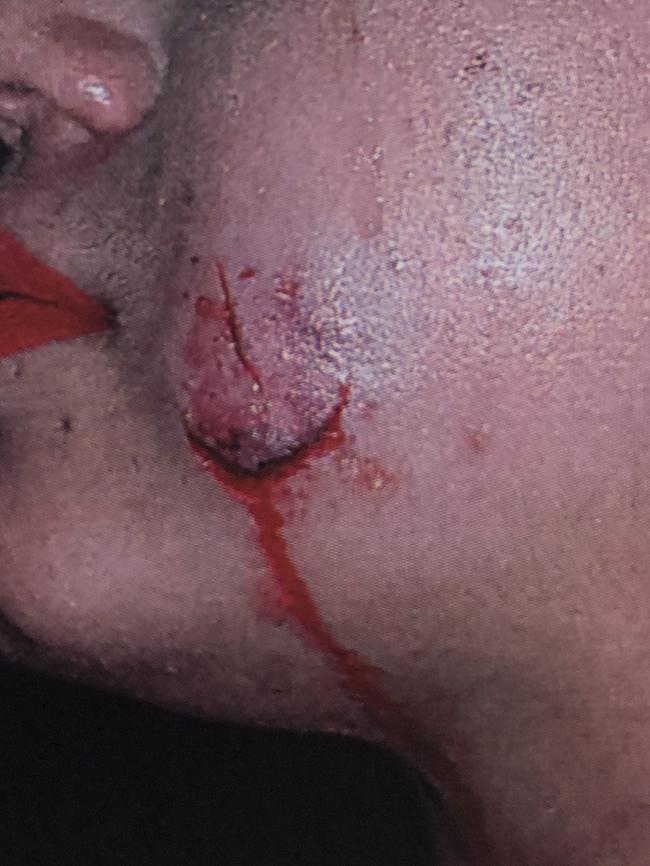 Images of the 3cm laceration caused when Hall bit the victim’s cheek.