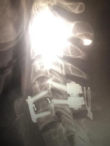 Nathan almost severed his spinal cord after the fall and had to have four bolts and two plates inserted into his vertebrae. Picture: Supplied