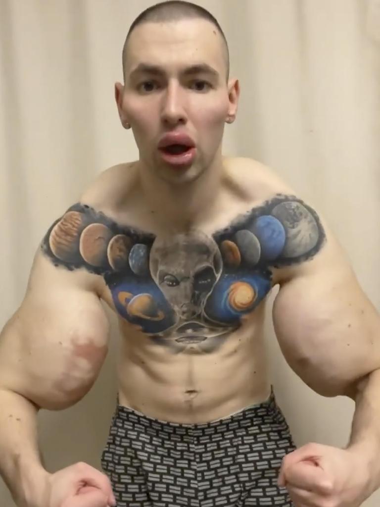 The man has been warned to remove the implants from his arms.