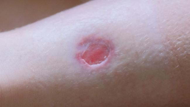 A Buruli ulcer.