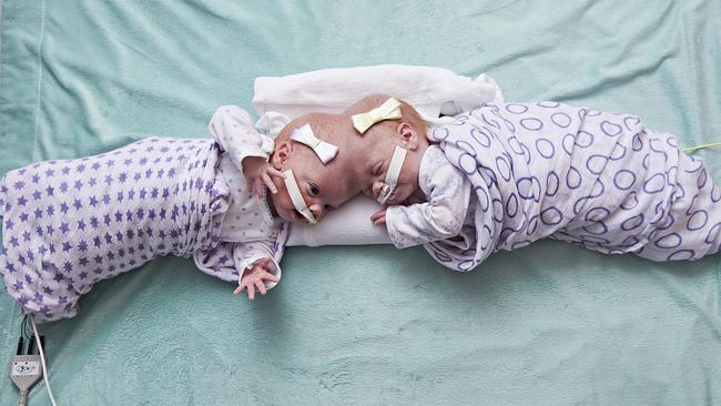 Conjoined Twins Separated Successfully At 10 Months Old Au — Australia’s Leading News