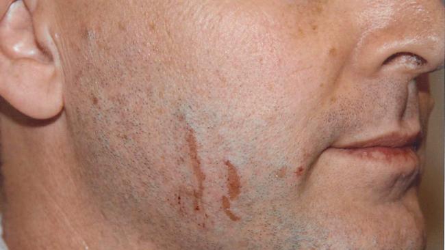 Court exhibit of scratches on the face of Gerard Baden-Clay which he claims were from a shaver.