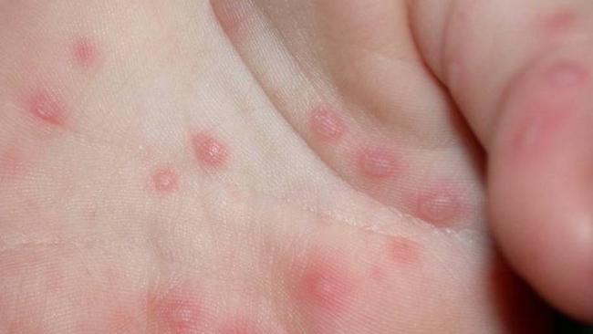 Some patients can have the Coxsackie virus, which causes hand, foot and mouth disease without showing symptoms like hand blisters.