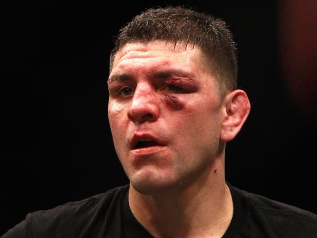 Diaz was banged up in a unanimous decision loss to Silva.